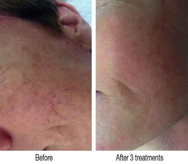 Facial broken capillaries treatment