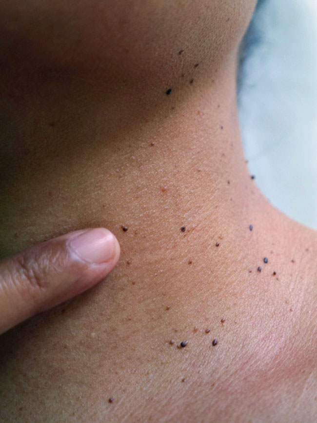 fine wire diathermy treatment newcastle