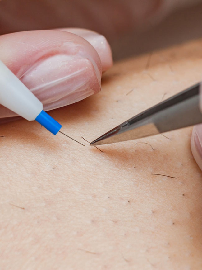 electrolysis treatment newcastle