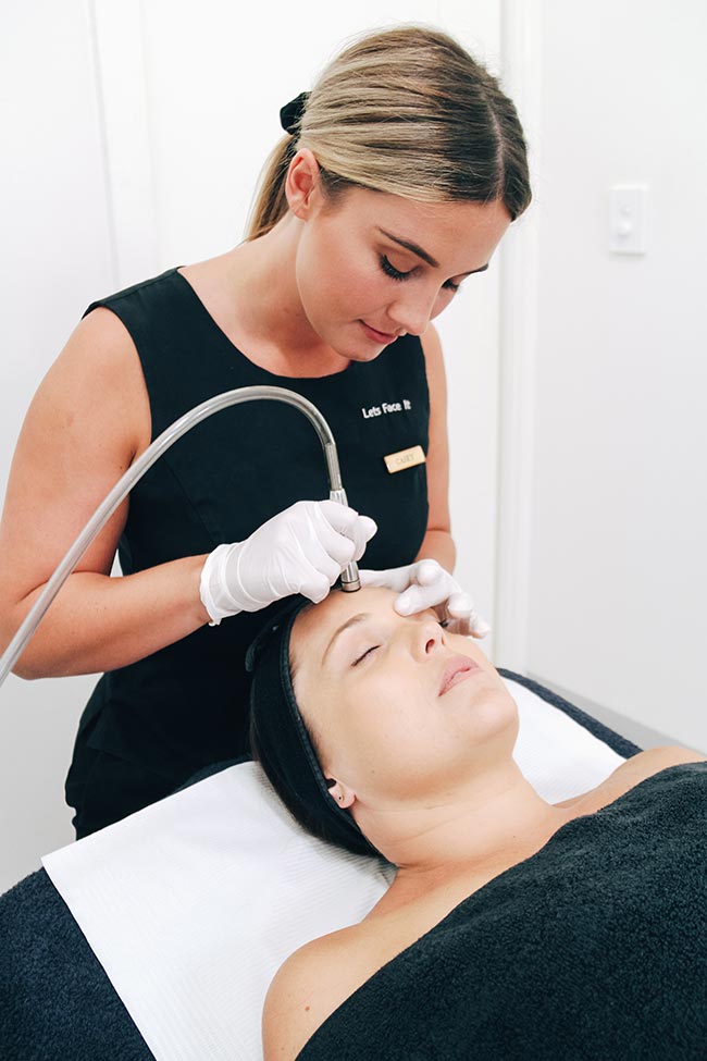 microdermabrasion treatment