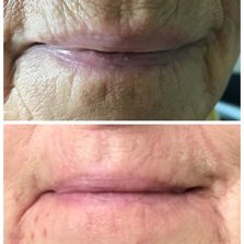 skin tightening treat areas
